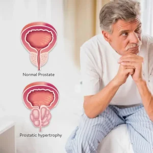 prostate-enlargement-dedayo-roots